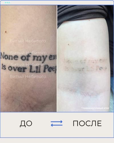 Удаление татуировки